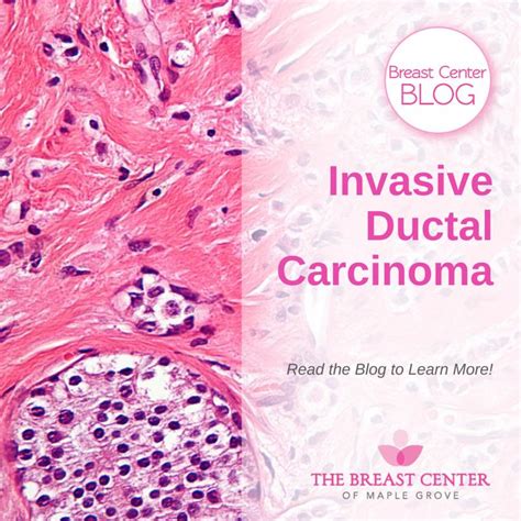 Invasive Ductal Carcinoma | IDC Breast Cancer | BCMG