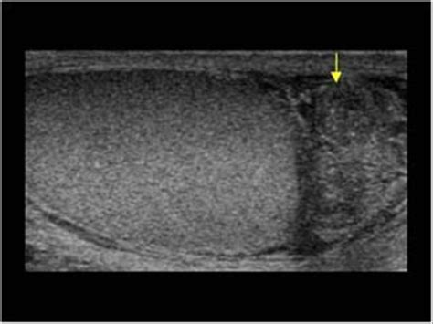 Urinary Tract and male reproductive system | 2.3 Scrotum : Case 2.3.6 Inflammation | Ultrasound ...