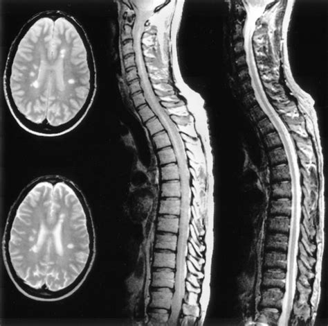 4.1 Damage of the myelin in the brain and spinal cord. | Download Scientific Diagram