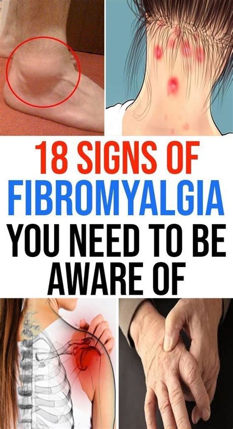 43 Signs of Fibromyalgia You Should Be Aware Of Outstanding | Signs of ...