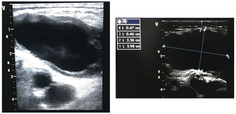 Ultrasound-Guided Thrombin Injection for Treating Iatrogenic Femoral ...