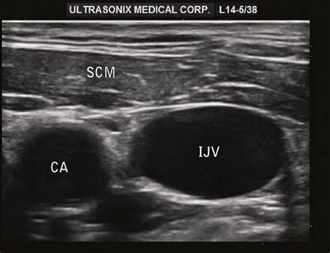 Ultrasound Leadership Academy: Central Line Placement — EM Curious