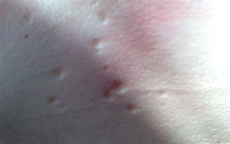 Lots of spots under skin on chest, small lumps – what are they? please ...