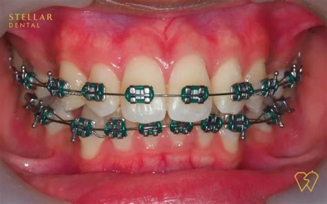 Braces Colors: Top Picks For 2023 - Stellar Dental