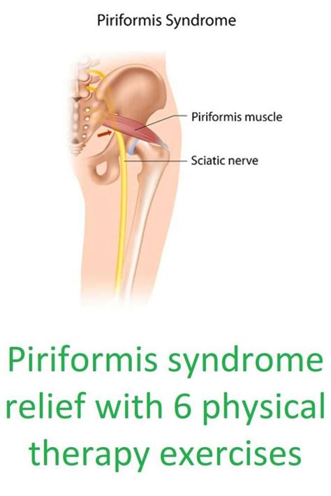 Piriformis syndrome relief with 6 physical therapy exercises