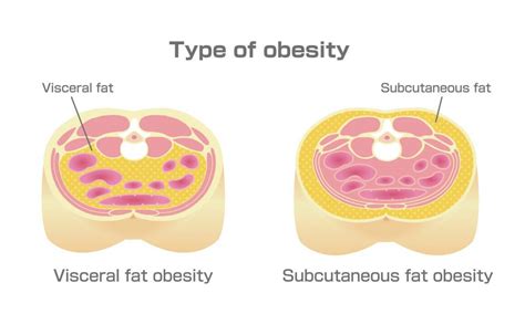 Type of obesity illustration. Abdominal sectional View. (visceral fat , subcutaneous fat ...