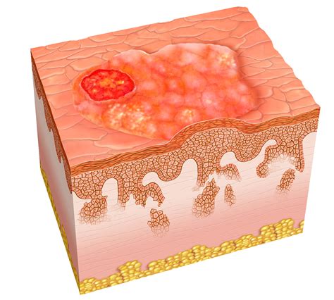 Squamous Cell Carcinoma - Net Health Book