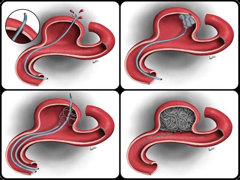 Aneurysm Coiling Complications :: Behance