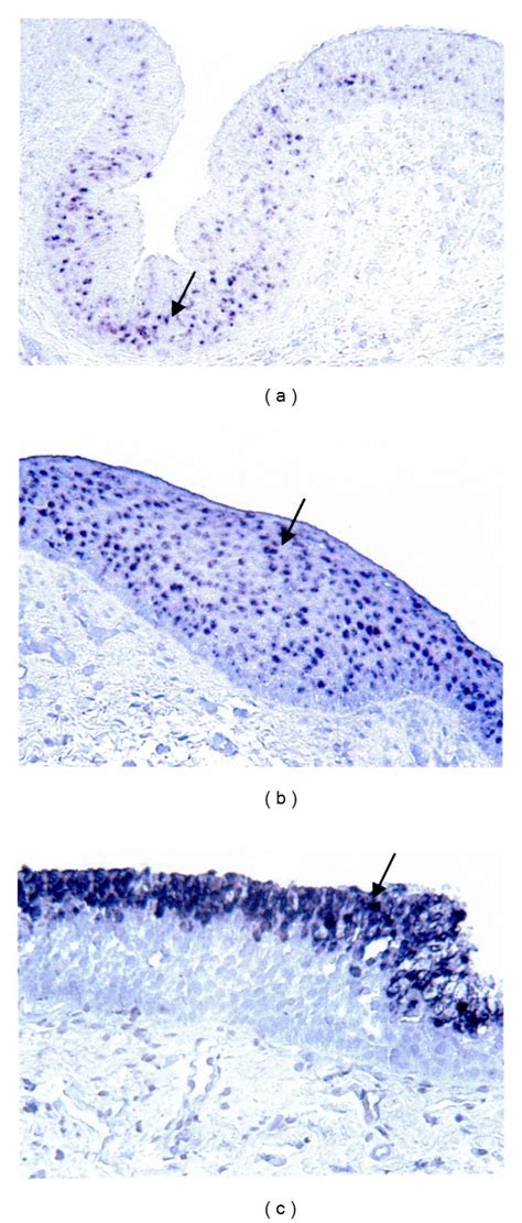 Mucin gene expression in laryngopharyngeal reflux mucosa. In situ ...