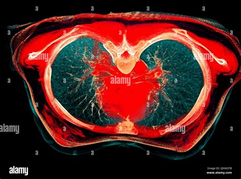 Normal lung, CT scan Stock Photo - Alamy