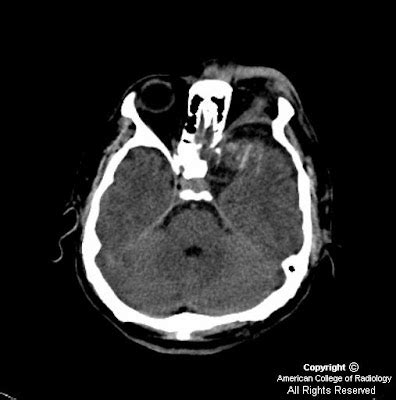 Neuroradiology On the Net: Sphenoid wing dysplasia