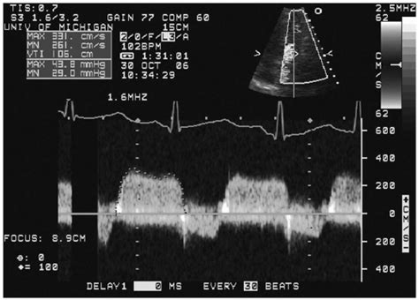 Mitral Stenosis | Thoracic Key