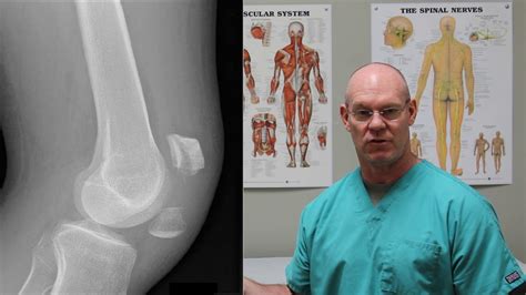 Broken KNEECAP | Fracture Friday Episode 28 - YouTube