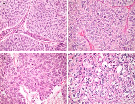 Urothelial carcinoma of the upper urinary tract. Tumor grades according... | Download Scientific ...