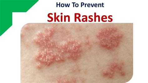 How To Prevent Skin Rashes With Home Remedies - YouTube