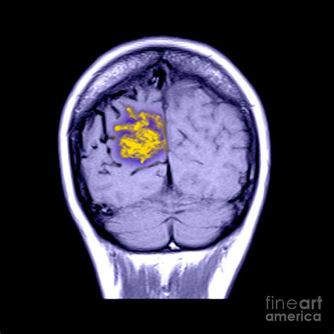 Mri Of Arterial Venous Malformation Photograph by Medical Body Scans - Fine Art America