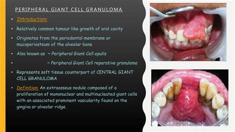 Peripheral and central giant cell granuloma