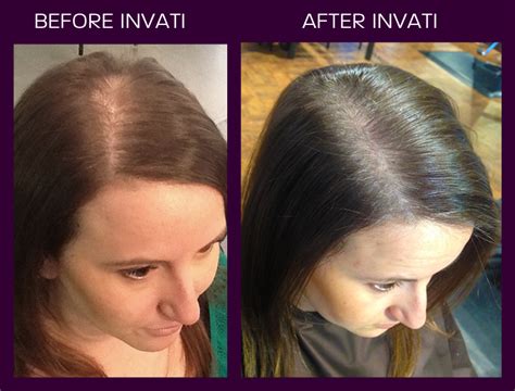 Aveda Invati before and after. This is a naturally derived 3-product system to help reduce hair ...