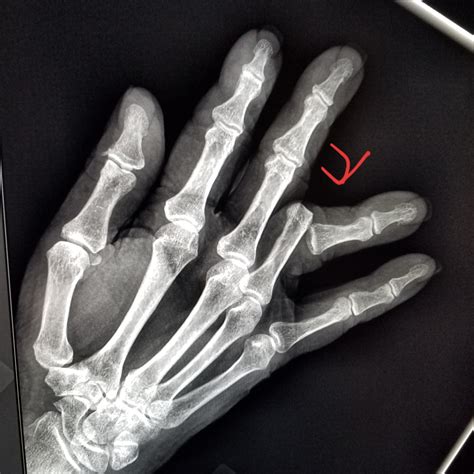 Pin on X-rays