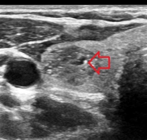 Inspissated Colloid In A Thyroid Nodule Radiology Case