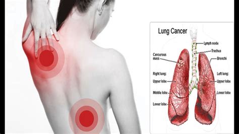 Lung Cancer Symptoms All Most Common Signs Of Lung Cancer Full | Hot ...