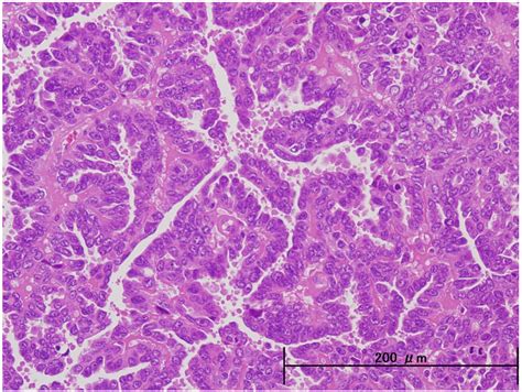 Endometrial Carcinoma Histology