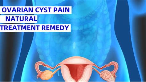 ovarian cyst pain natural treatment remedy - YouTube