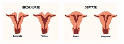 Heart Shaped Uterus and Your Fertility // Utero en forma de corazon y tu fertilidad - The Latina Doc