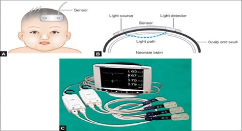 Cerebral oximetry sensor. | Download Scientific Diagram