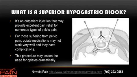 Superior Hypogastric Plexus Block Explained by a Las Vegas Pain Center ...