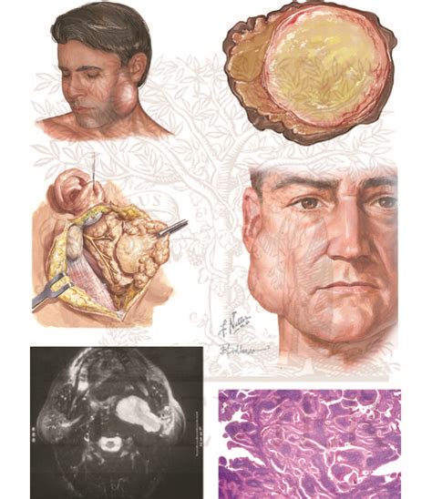 Benign Tumors of the Salivary Glands