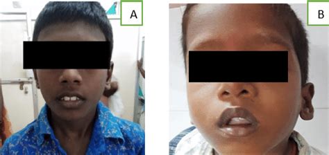 A,B:Depicting adenoid facies | Download Scientific Diagram