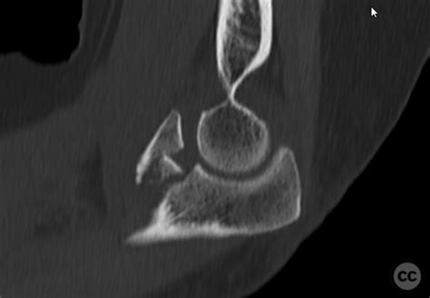 O'Driscoll type 3 coronoid fracture dislocation