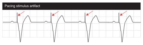 Components and construction of a pacemaker – Cardiovascular Education