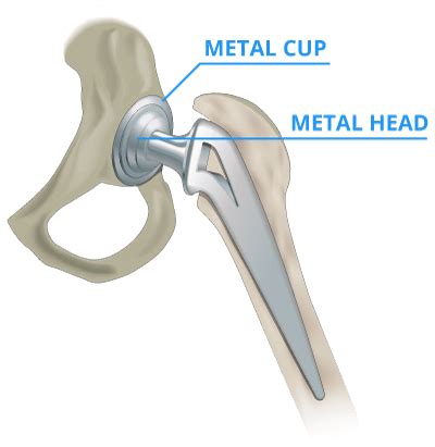 Metallosis: Symptoms of Metal Poisoning from Hip Replacement