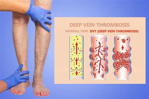 Blood Clots - Radiology Services | LAIIC – LA Imaging & Interventional ...