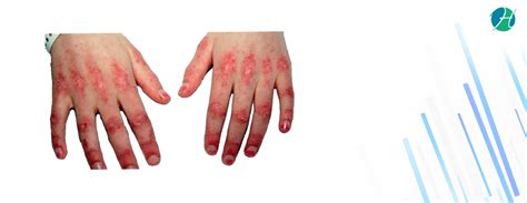 Polymyositis – Causes, Symptoms, Diagnosis, Treatment | Rheumatology ...