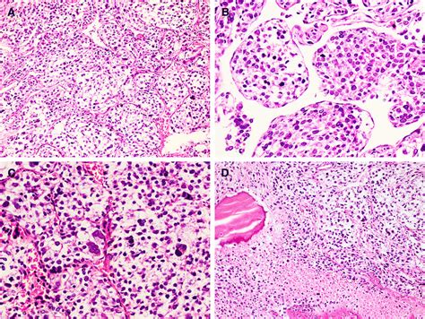 Histology. Epithelioid cells arranged in nested pattern with delicate ...