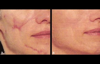 10 things to know before having laser treatment for your scar