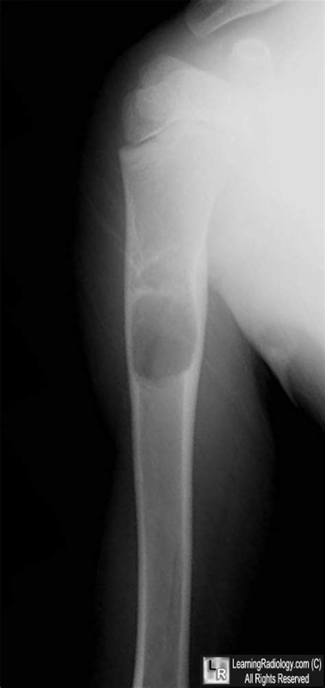 LearningRadiology - unicameral, bone, cyst, solitary, simple, fallen ...