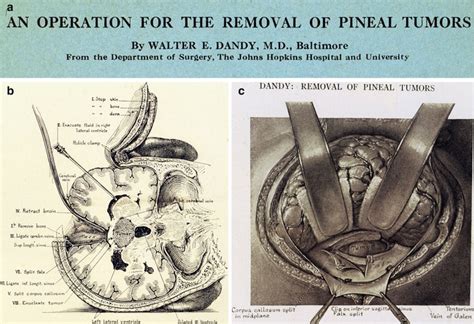 History of Posterior Fossa Tumor Surgery | Neupsy Key