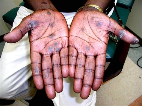 Syphilitic lesions on the hands. | Download Scientific Diagram