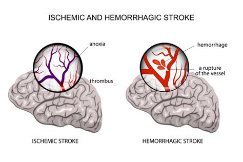 Deadly Stroke Triggers and How to Lower Your Stroke Risk Naturally - Home Cures That Work