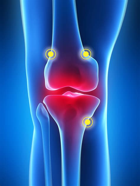 FDA Clears Radiofrequency Treatment for Osteoarthritis Knee Pain