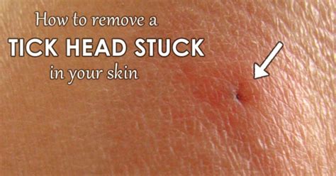 How to Remove a Tick Head Stuck in Your Skin - Mom Goes Camping