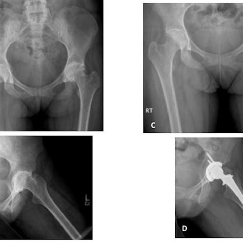 Degenerative arthritis of the left hip due to Juvenile Idiopathic ...