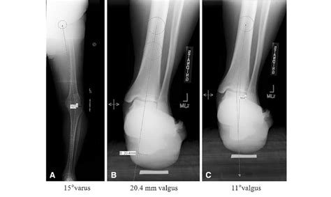 A-C (A) Mechanical axis alignment shows varus knee deformity. (B)... | Download Scientific Diagram