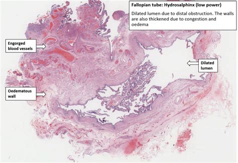 Fallopian Tube – Hydrosalpinx – NUS Pathweb :: NUS Pathweb