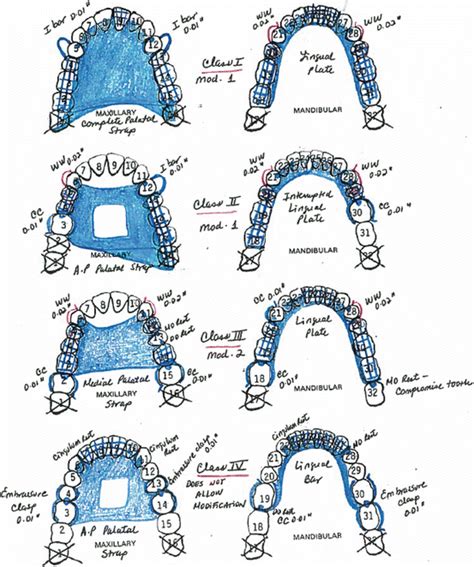 Removable Partial Dentures (RPD) Treatment: A Clinical Guide | Pocket ...