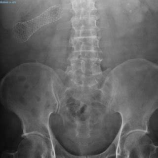 Post procedure X-ray colonic stent (sigmoid colon). | Download Scientific Diagram